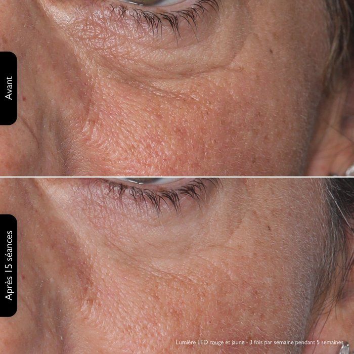 Silk'n Lumino LED Mask - 100 LEDs - Anti-Aging/ Anti-Imperfections 100leds